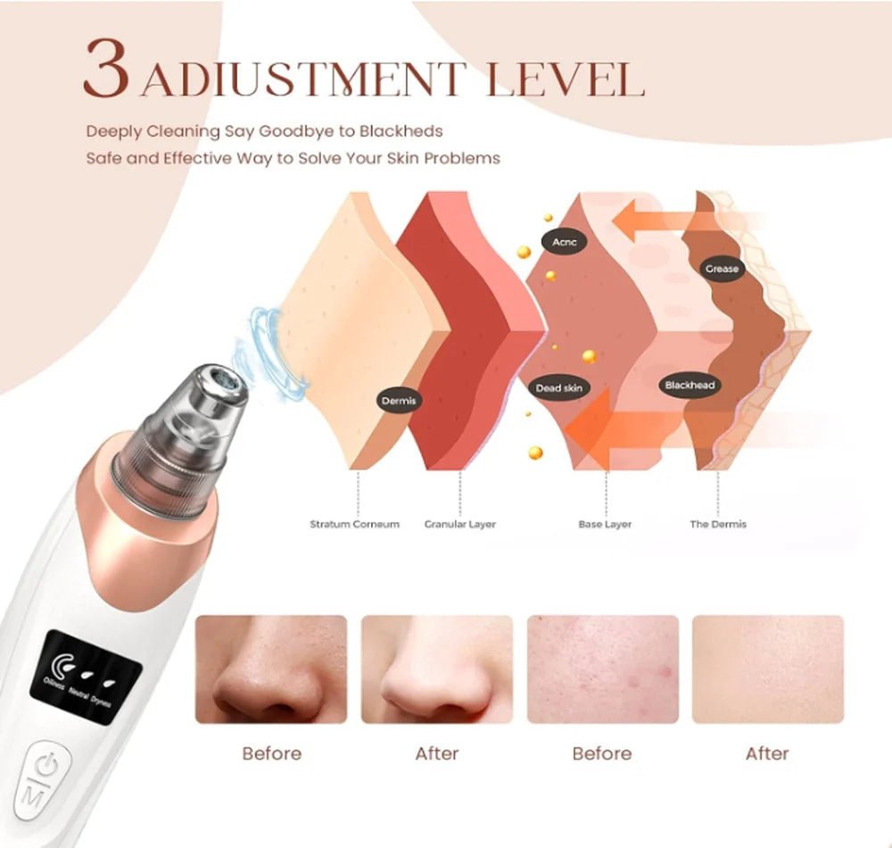 Blackhead Acne Remover For Deep Pore Cleansing 5 in 1 - VAULTMART