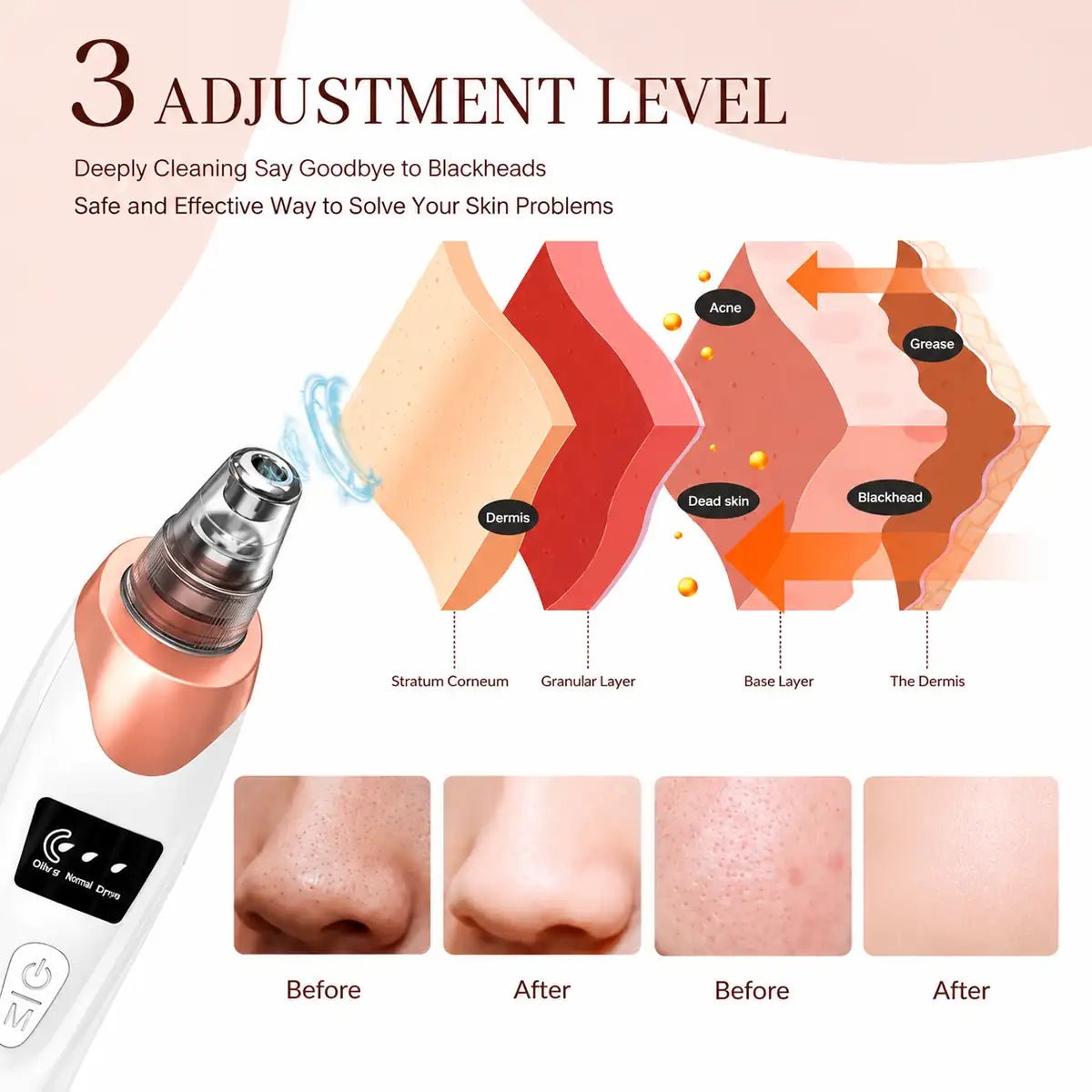 Blackhead Acne Remover For Deep Pore Cleansing 5 in 1 - ETHEREAL