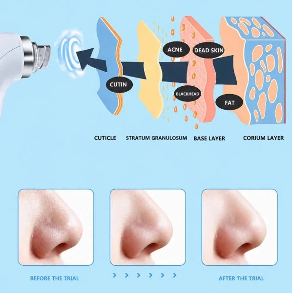 Hydrafacial Blackhead Acne Remover Machine - ETHEREAL